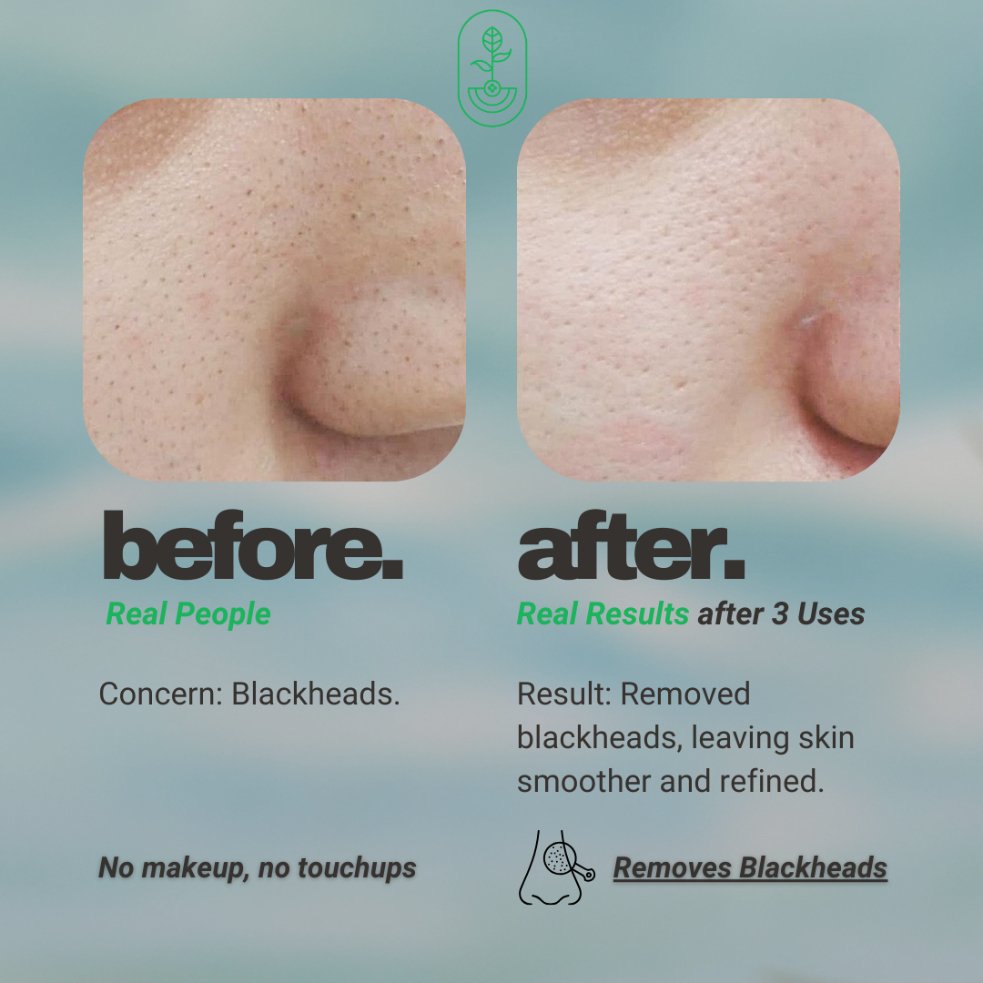 Before and after image showing the results of using Otanics De-Tan Face Pack. The left side shows the 'before' image with visible blackheads, while the right side shows the 'after' image, showcasing smooth skin with visibly reduced blackheads after 3 uses. Both images highlight that no makeup or touchups were used. Text emphasizes the skin concern and the product's effectiveness in removing blackheads and leaving the skin smoother and more refined.