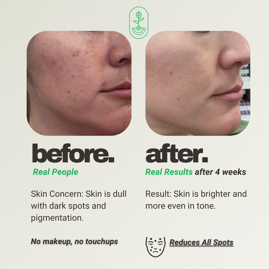 Otanics Anti Pigmentation & Dark Spots Removal Gel with Hyaluronic Acid & Niacinamide | All Skin Types | Women & Men | 100g