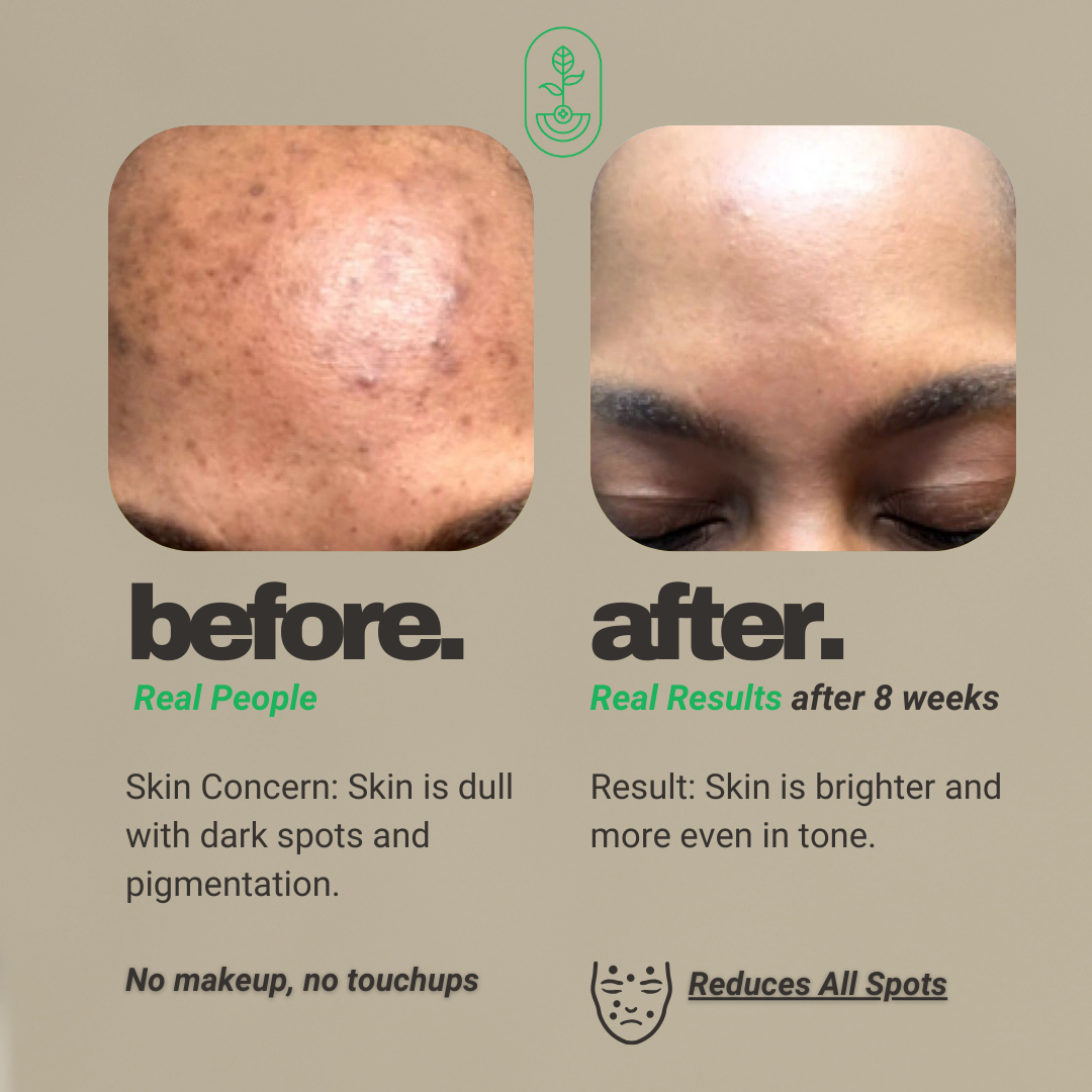 Before and after image showing the results of using Otanics Anti-Pigmentation Face Pack. The left side shows the 'before' image with dull skin and visible dark spots on the forehead, while the right side shows the 'after' image, showcasing brighter, more even skin tone after 8 weeks of use. Both images emphasize that no makeup or touchups were used. Text highlights the skin concern and the product's effectiveness in reducing dark spots and pigmentation.