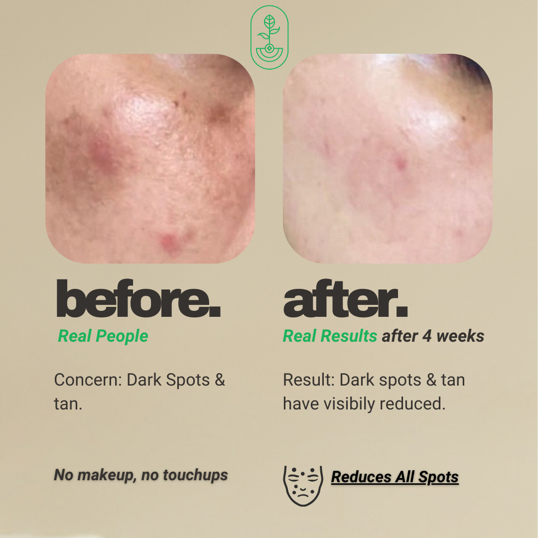 Otanics Spot Removal Gel | Reduce Dark Spots, Acne Scars & Tan with Hyaluronic Acid & Vitamin C | All Skin Types | Women & Men | 100g