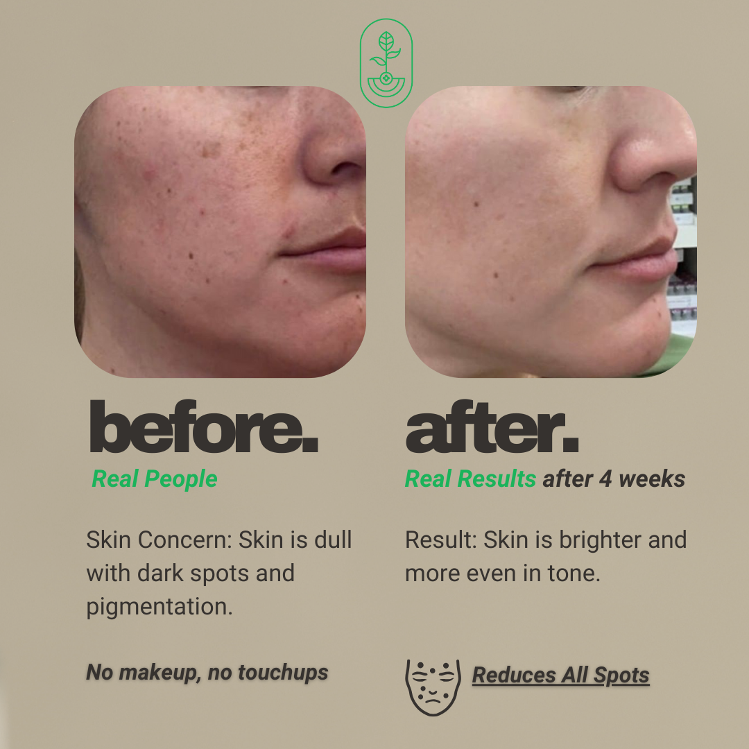 Before and after image showing the results of using Otanics Anti-Pigmentation Face Pack. The left side shows the 'before' image with dull skin and dark spots, while the right side shows the 'after' image, showcasing brighter, more even skin tone after 4 weeks of use. Both images emphasize that no makeup or touchups were used. Text highlights the skin concern and the product's effectiveness in reducing dark spots and pigmentation.