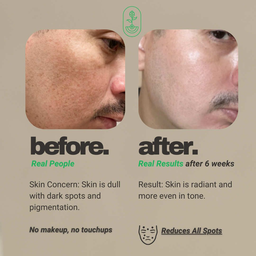 Before and after image showing the results of using Otanics Anti-Pigmentation Face Pack. The left side shows the 'before' image with dull skin and visible dark spots, while the right side shows the 'after' image, showcasing radiant skin and a more even tone after 6 weeks of use. Both images highlight that no makeup or touchups were used. Text emphasizes the skin concern and the product's effectiveness in reducing pigmentation and dark spots.