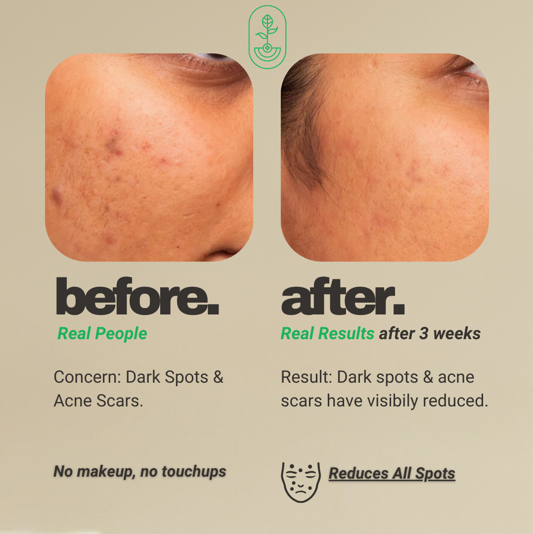 Otanics Spot Removal Gel | Reduce Dark Spots, Acne Scars & Tan with Hyaluronic Acid & Vitamin C | All Skin Types | Women & Men | 100g