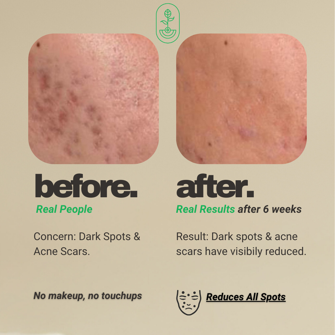 Otanics Spot Removal Gel | Reduce Dark Spots, Acne Scars & Tan with Hyaluronic Acid & Vitamin C | All Skin Types | Women & Men | 100g