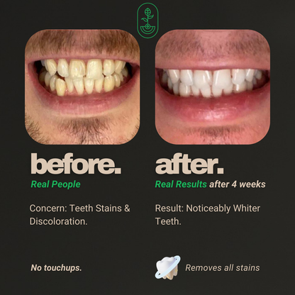 Before and after comparison of customer using Otanics Teeth Whitening Powder, ‘real people’ and ‘real results’ text with Otanics logo, concerns about teeth stains, and noticeable whitening results